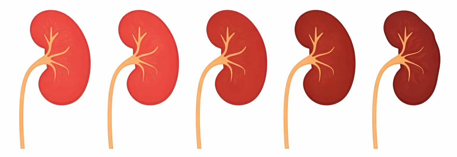 Chronische nierinsufficiëntie: van onderdiagnose naar overzicht met populatiemanagement